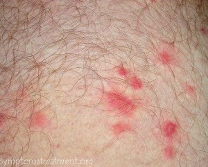 What are some non-toxic methods for removing chiggers?